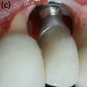 Peri-implantitis defect configuration after complete granulation tissue  debridement.