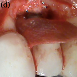 OS+Tobra and OS+Vanco applied in the defect