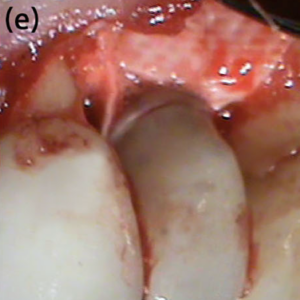 Collagen membrane covering the entire defect