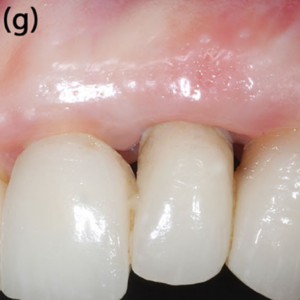 Clinical situation at 12-month follow-up.