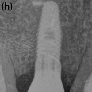 Radiographic examination at 12-month follow-up